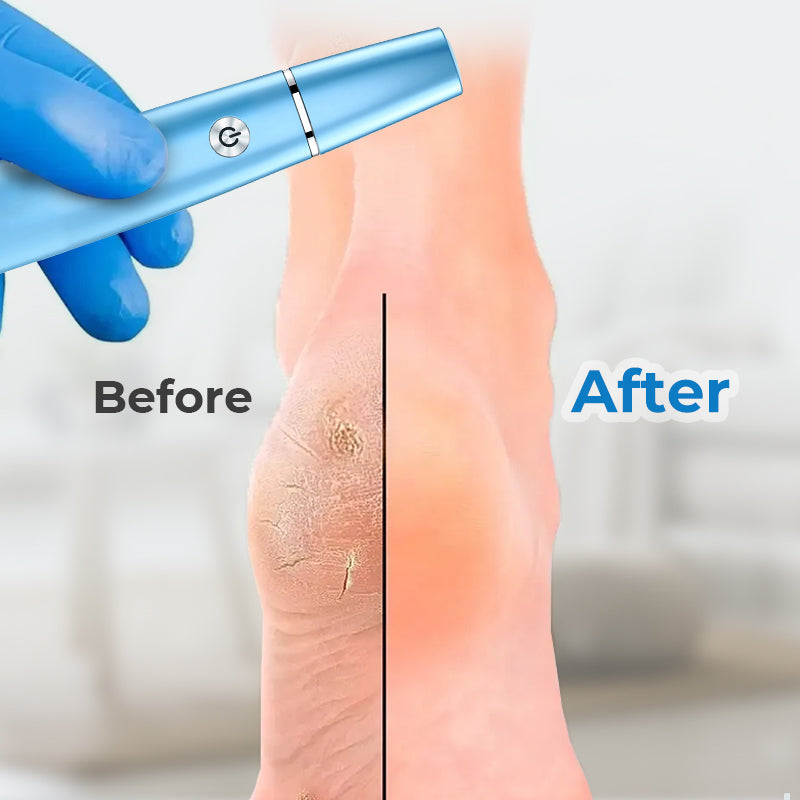 🔥Spring Sale - 50% OFF🔥Electric Feet Callus Remover⚡